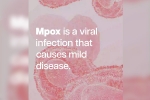 mpox in Congo, who on mpox, mpox emergency again, Sweden