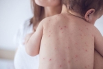 measles pictures, measles, measles back in the united states as children omit vaccination doses, Measles vaccination